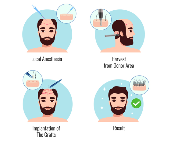 Fue Hair Transplant