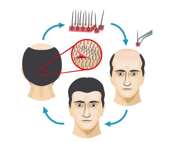 Hair Transplant