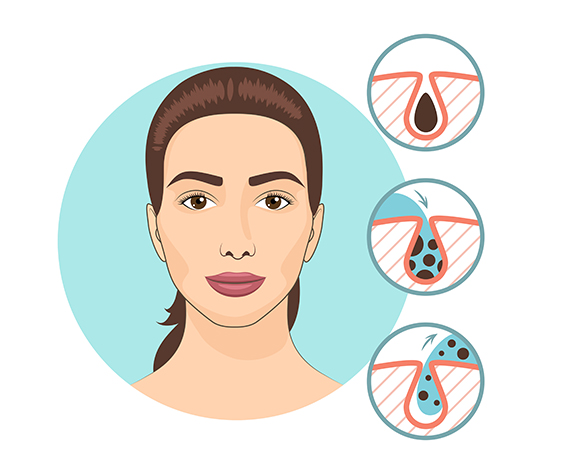 Chemical Peels Treatment